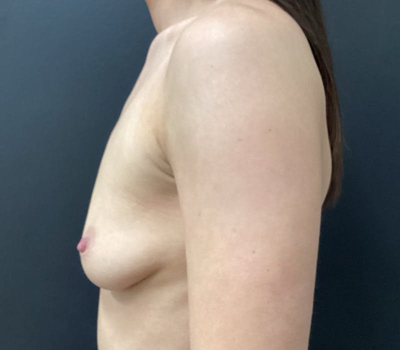 Preserve Motiva Breast Augmentation Before & After Gallery - Patient 307222 - Image 5