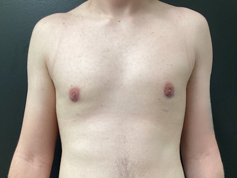 Gynecomastia Before & After Gallery - Patient 859629 - Image 2