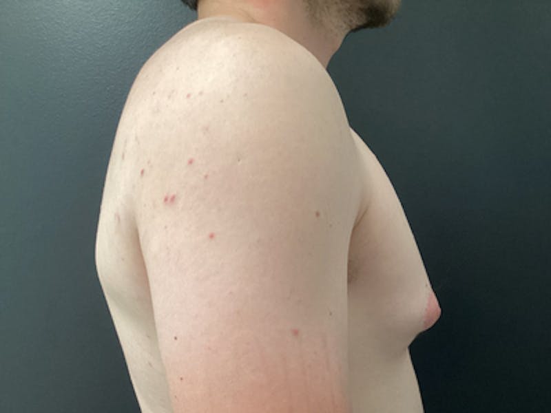 Gynecomastia Before & After Gallery - Patient 859629 - Image 3