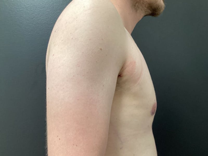 Gynecomastia Before & After Gallery - Patient 859629 - Image 4