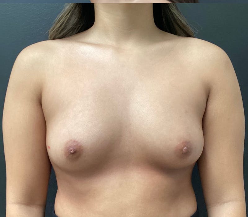 Preserve Motiva Breast Augmentation Before & After Gallery - Patient 294921 - Image 1