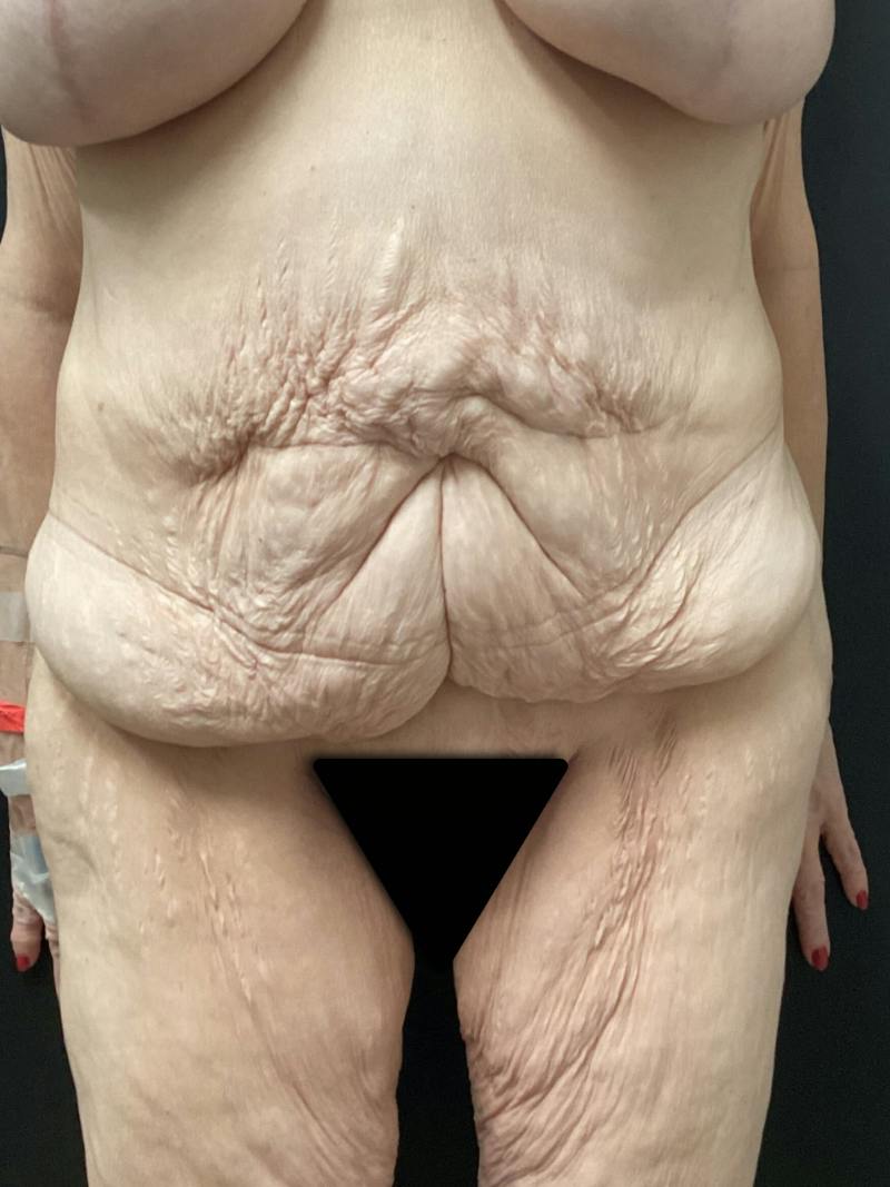 Abdominoplasty Before & After Gallery - Patient 721275 - Image 1