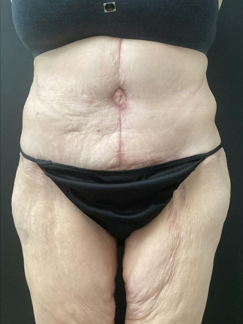Abdominoplasty Before & After Gallery - Patient 721275 - Image 2