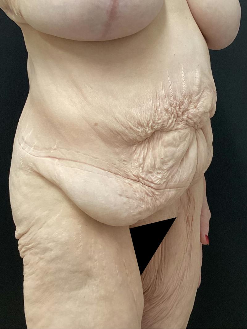 Abdominoplasty Before & After Gallery - Patient 721275 - Image 3