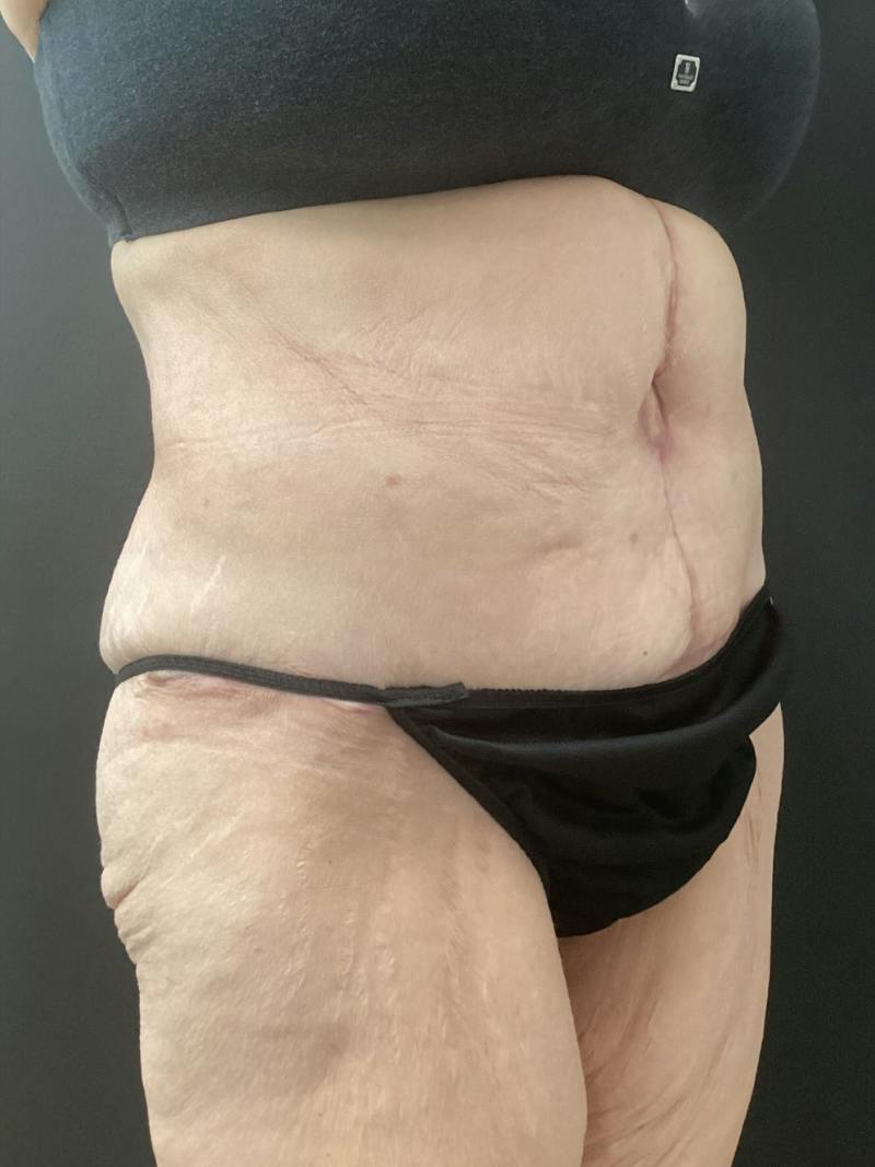 Abdominoplasty Before & After Gallery - Patient 721275 - Image 4