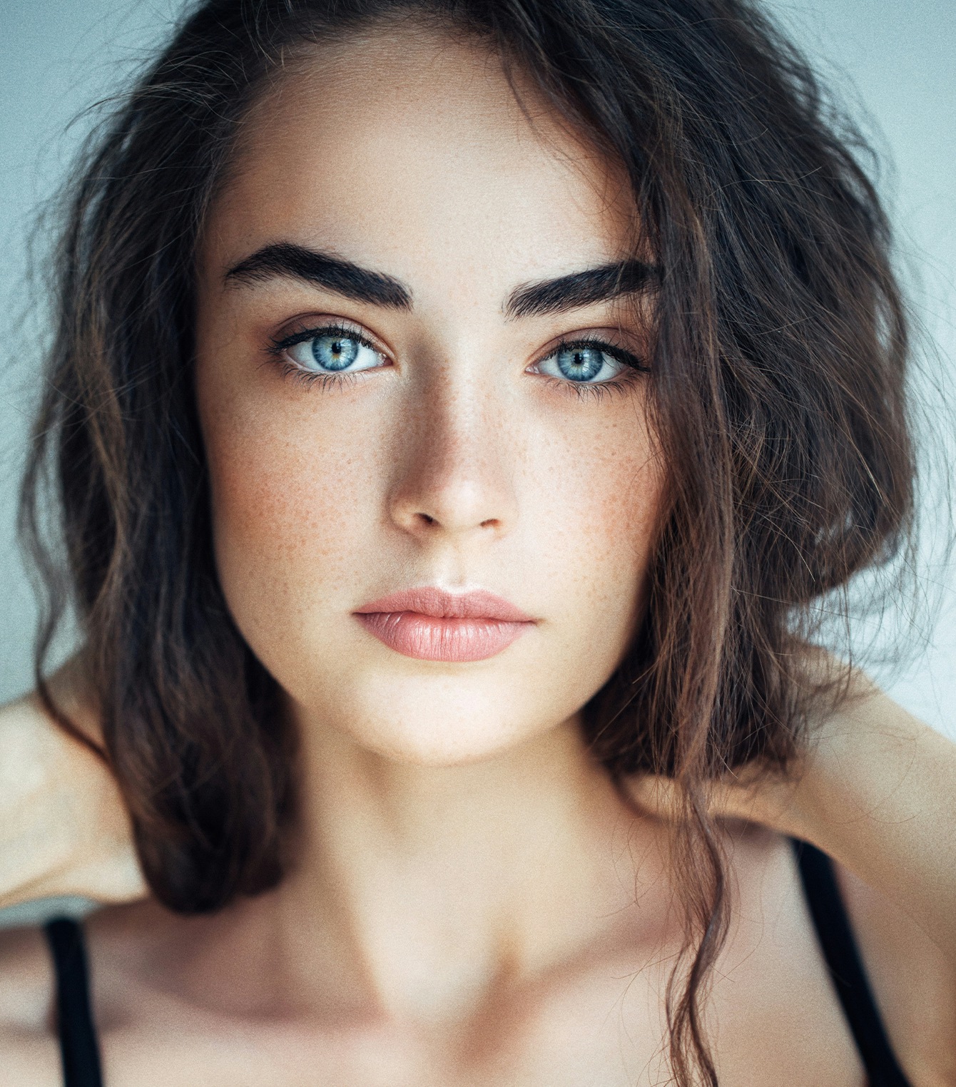 Woman who got belotero dermal filler