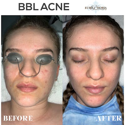 BBL® HERO™️ Before & After Gallery - Patient 54025047 - Image 1