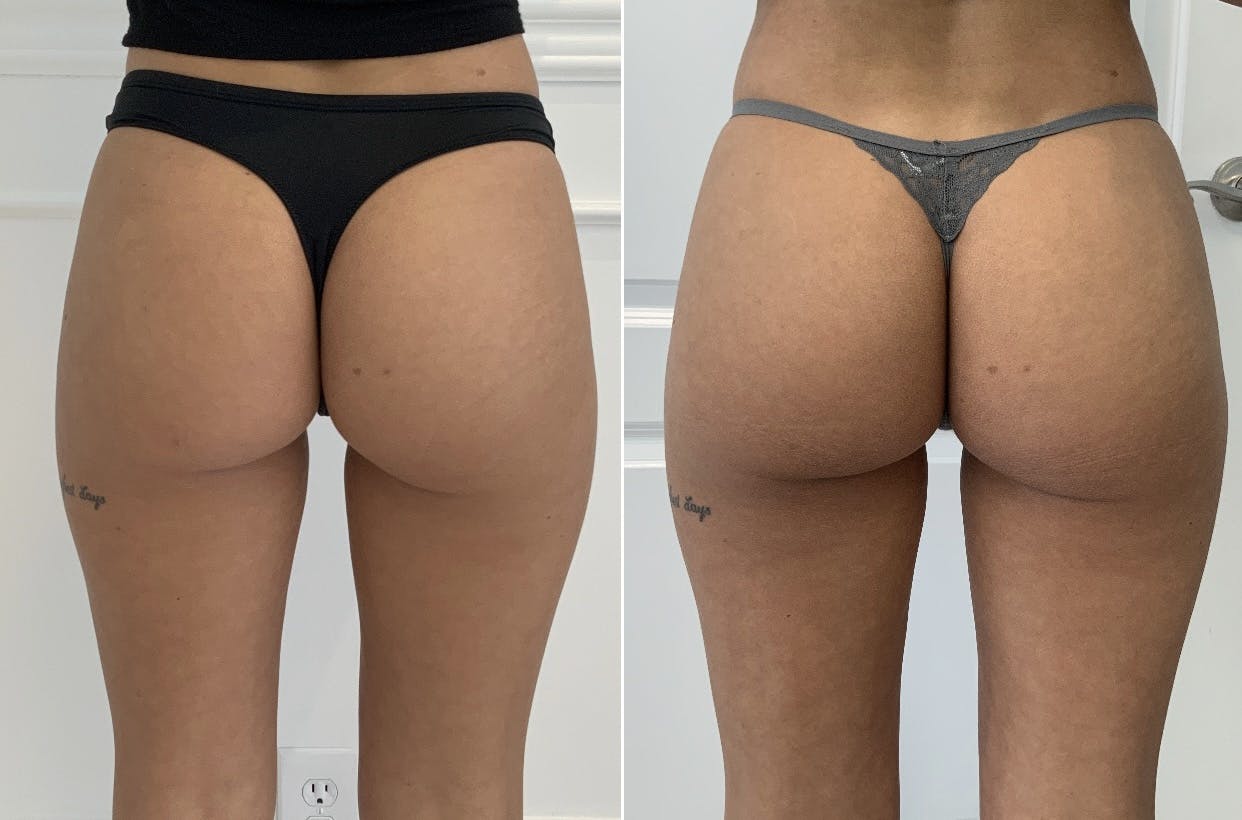 Booty-Ful Butt Lift® Before & After Gallery - Patient 65642127 - Image 1