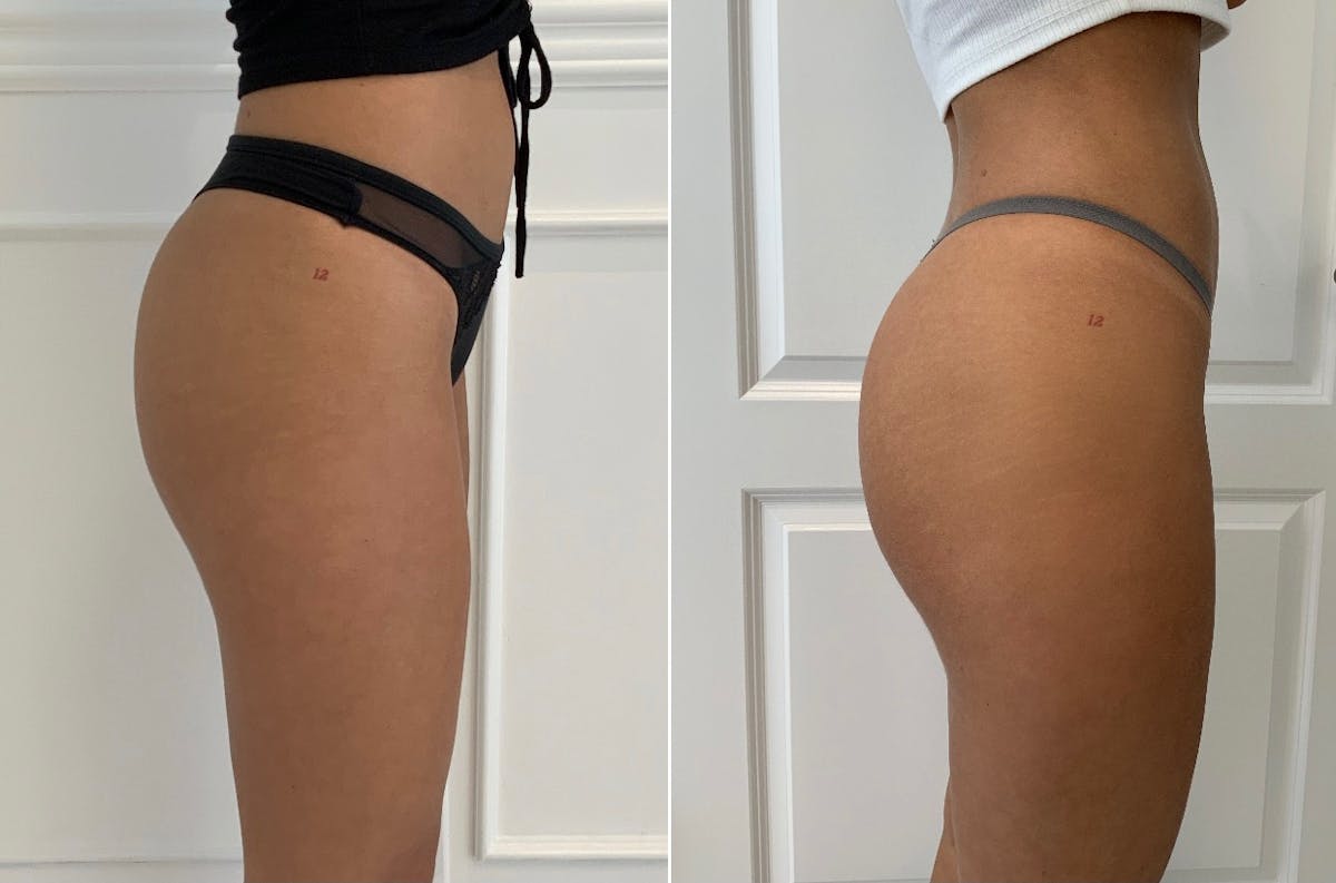 Booty-Ful Butt Lift® Before & After Gallery - Patient 65642127 - Image 2