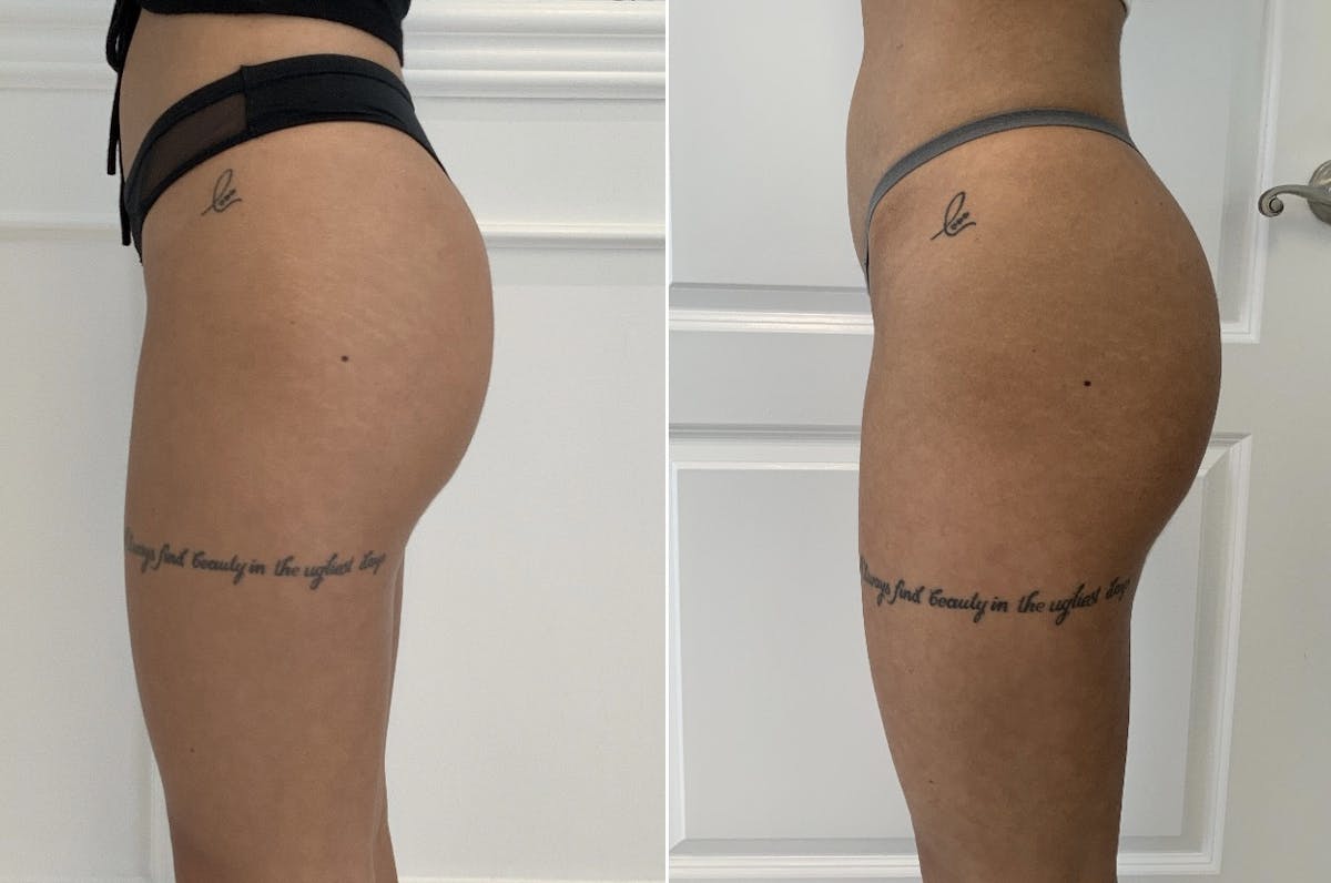 Booty-Ful Butt Lift® Before & After Gallery - Patient 65642127 - Image 3