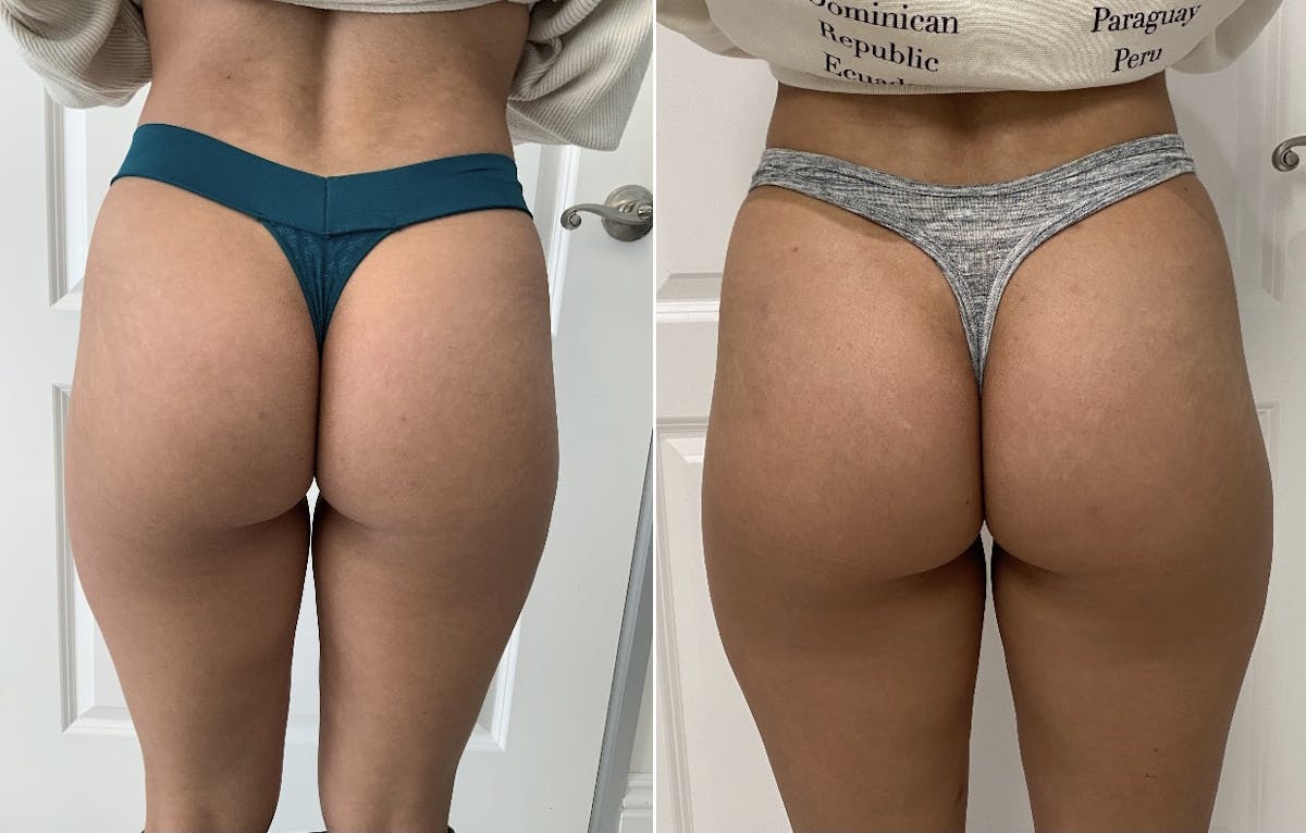 Patient 65642128  Booty-Ful Butt Lift® Before & After Photos