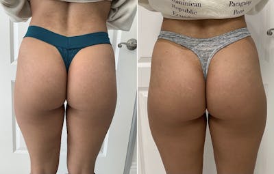Booty-Ful Butt Lift® Before & After Gallery - Patient 65642128 - Image 1