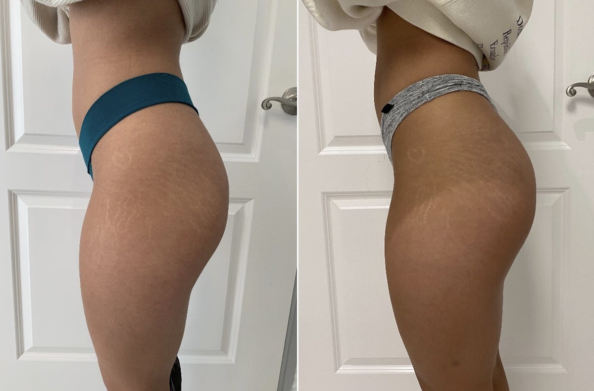 Patient 65642128  Booty-Ful Butt Lift® Before & After Photos