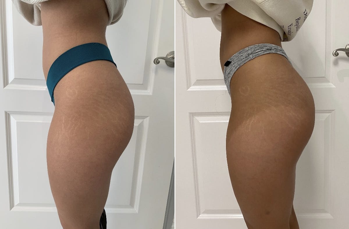 Booty-Ful Butt Lift® Before & After Gallery - Patient 65642128 - Image 2