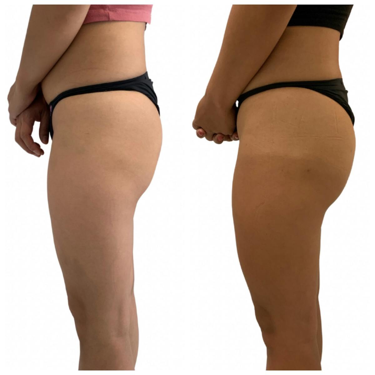 Booty-Ful Butt Lift® Before & After Gallery - Patient 65642130 - Image 1