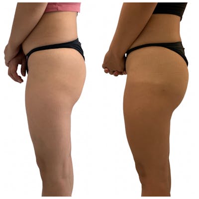 Booty-Ful Butt Lift® Before & After Gallery - Patient 65642130 - Image 1
