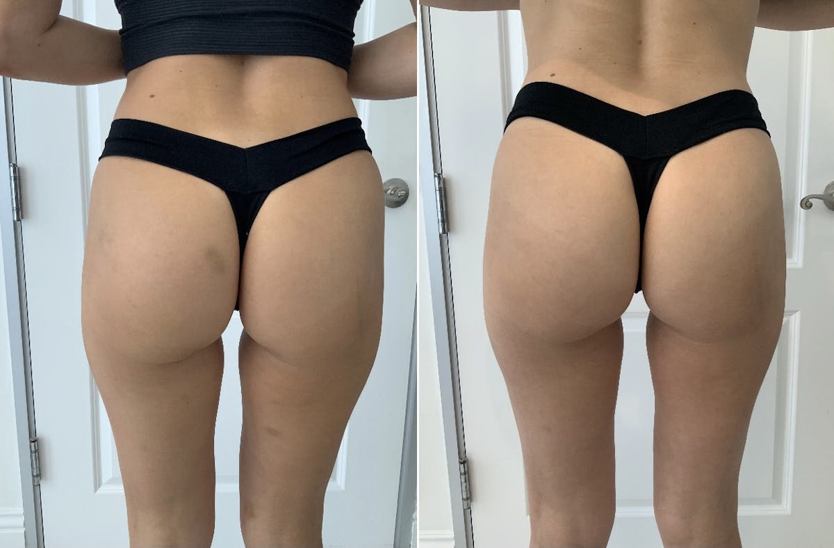 Booty-Ful Butt Lift® Before & After Gallery - Patient 65642129 - Image 1