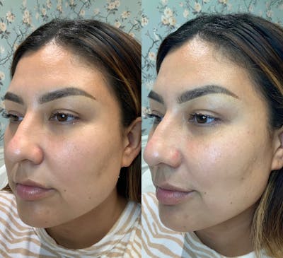 Dermal Fillers Before & After Gallery - Patient 65642140 - Image 1