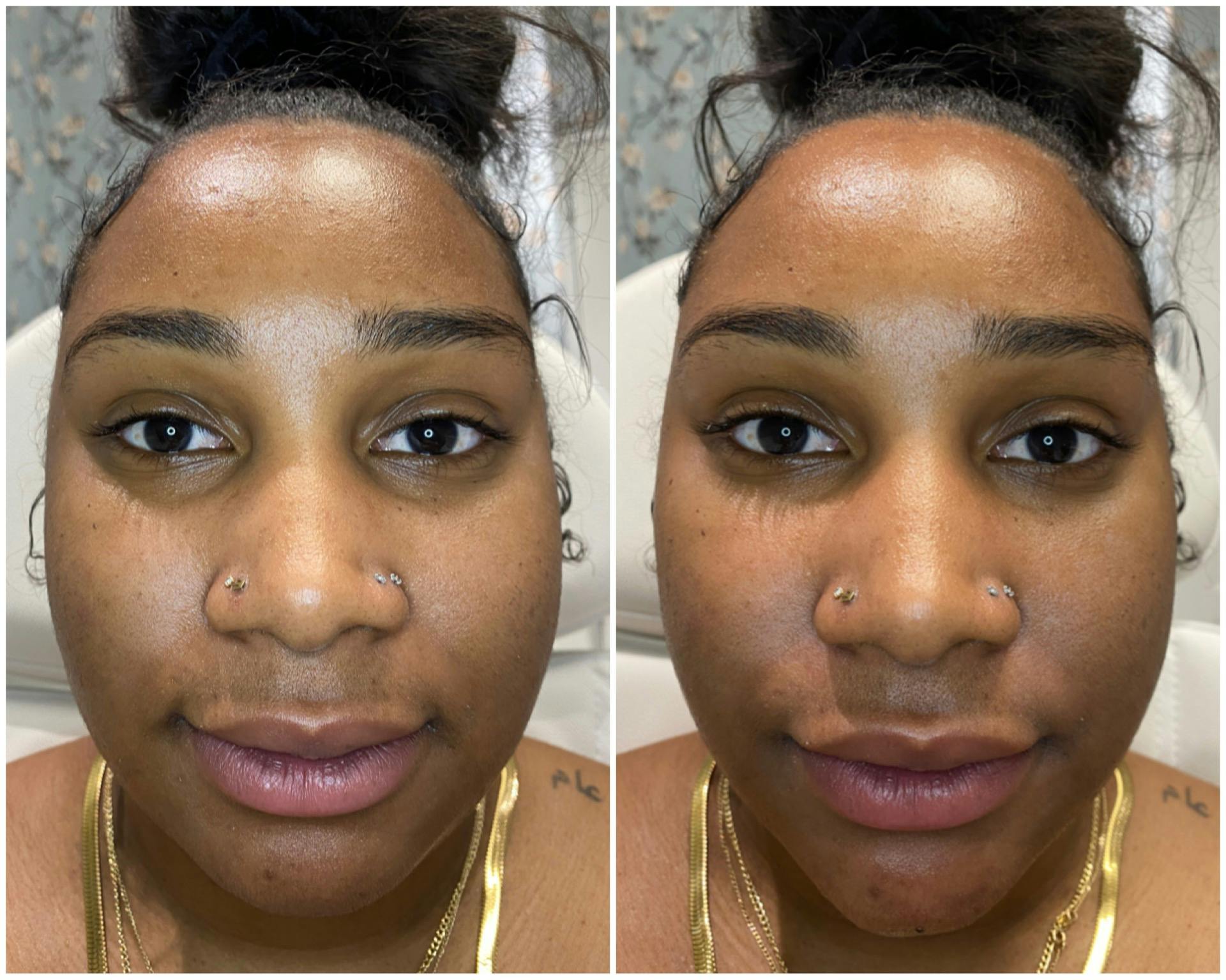 Dermal Fillers Before & After Gallery - Patient 65642142 - Image 2