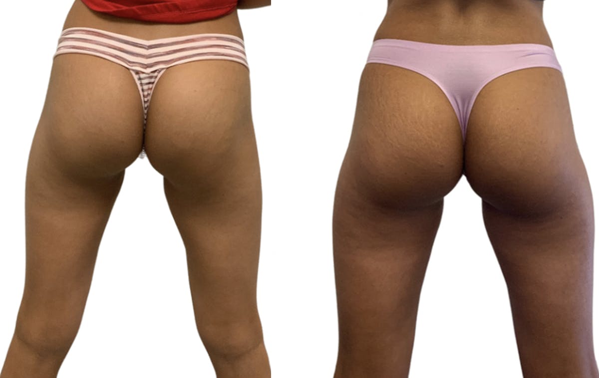 Booty-Ful Butt Lift® Before & After Gallery - Patient 65642144 - Image 1