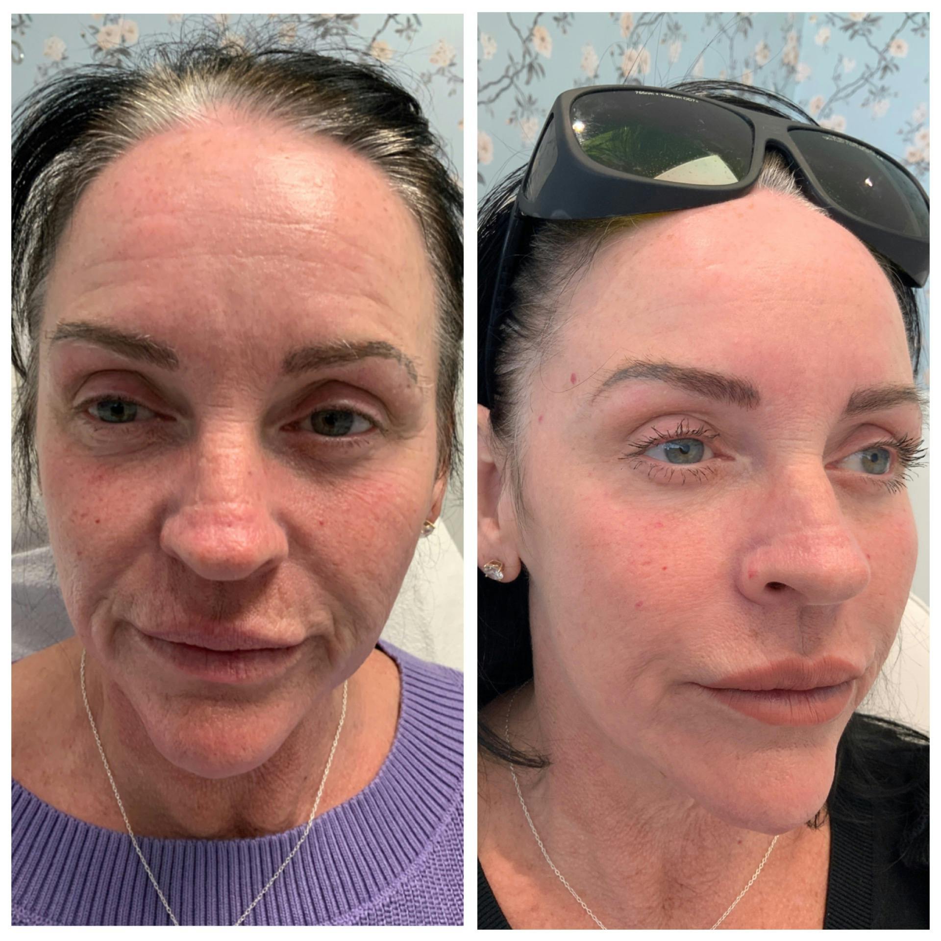 Dermal Fillers Before & After Gallery - Patient 65642154 - Image 1