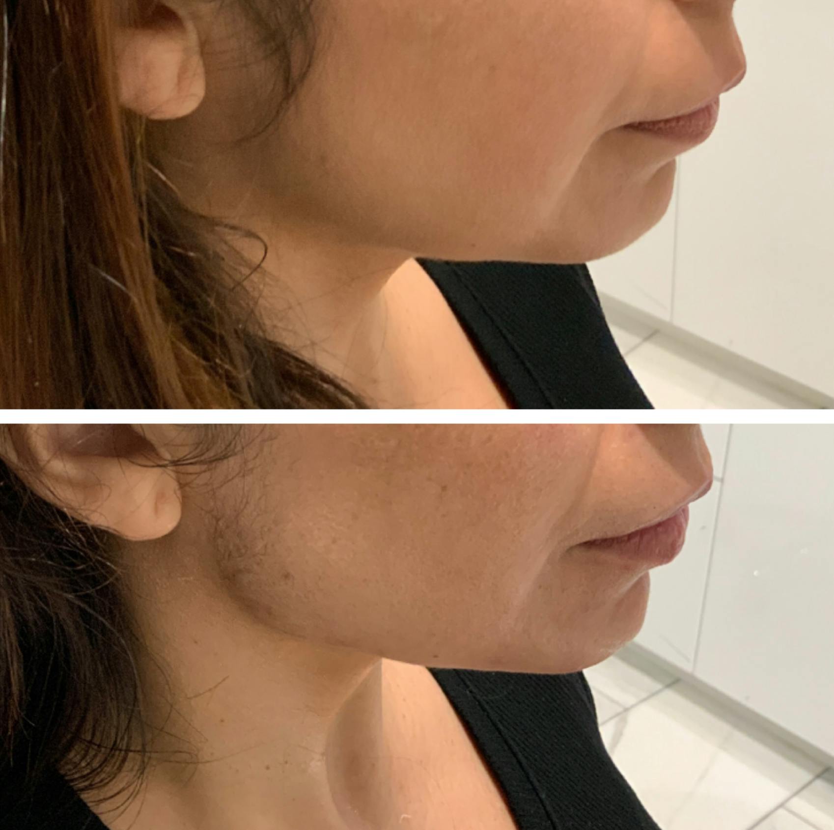 Dermal Fillers Before & After Gallery - Patient 65642155 - Image 1