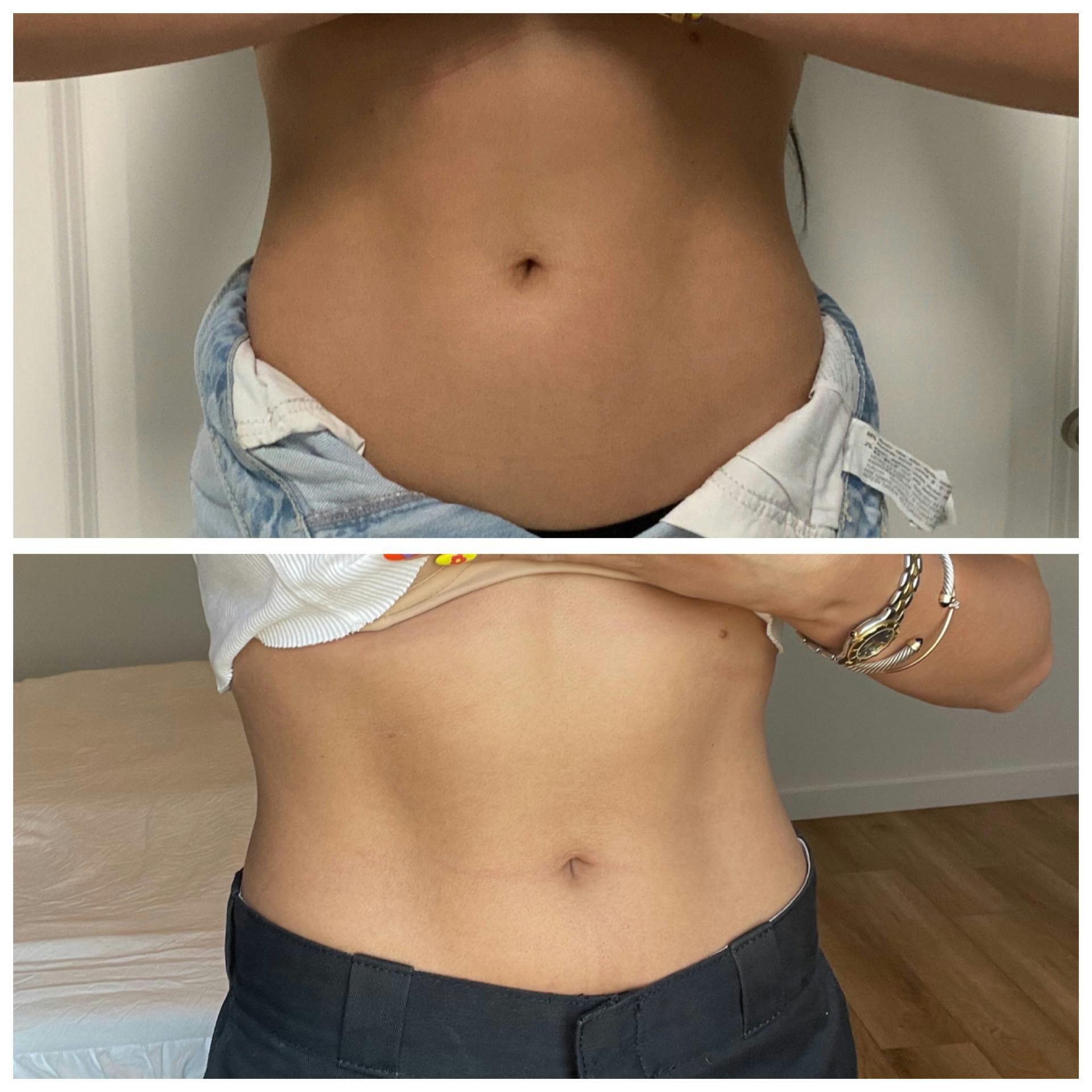 EmSculpt® Before & After Gallery - Patient 65642197 - Image 1