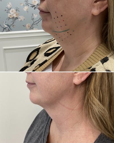 FAT BOMB (Face) Before & After Gallery - Patient 65642220 - Image 1