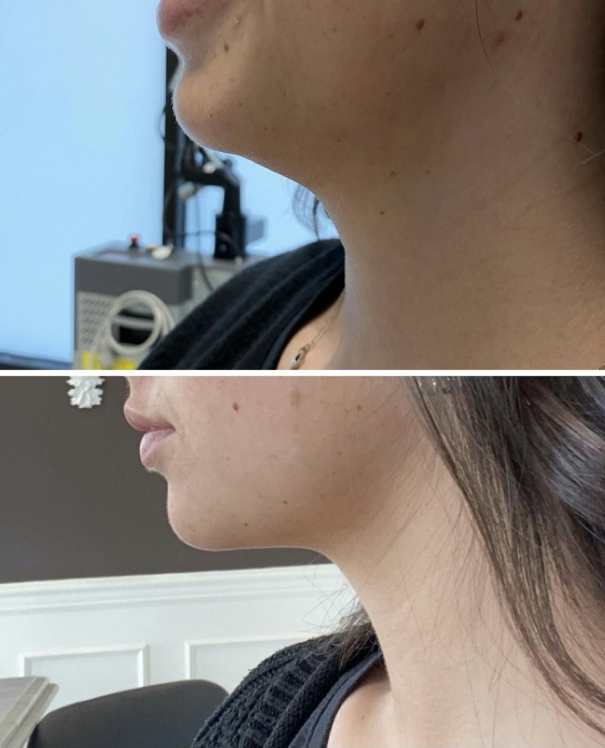 FAT BOMB (Face) Before & After Gallery - Patient 65642221 - Image 1