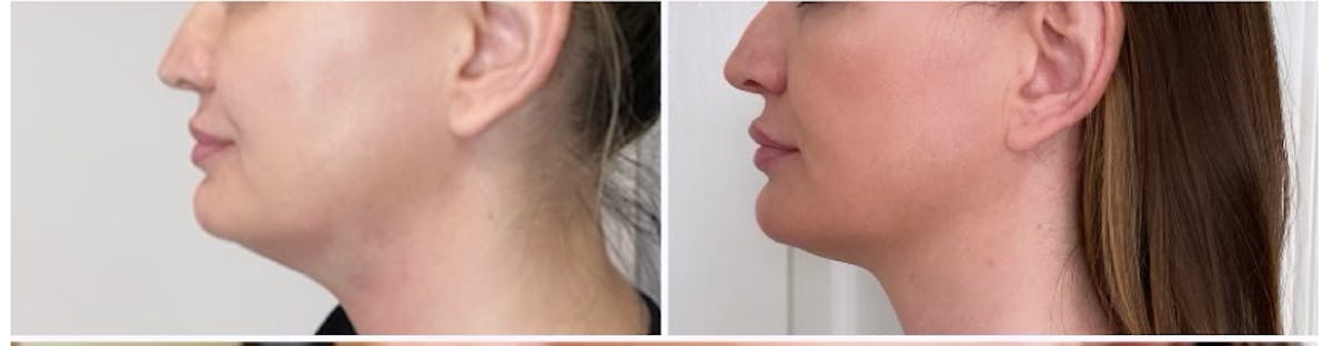 FAT BOMB (Face) Before & After Gallery - Patient 65642223 - Image 2