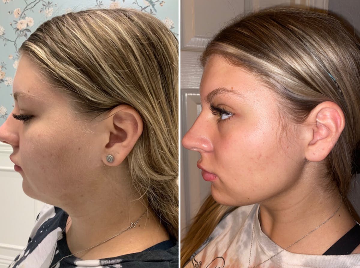 FAT BOMB (Face) Before & After Gallery - Patient 65643456 - Image 1