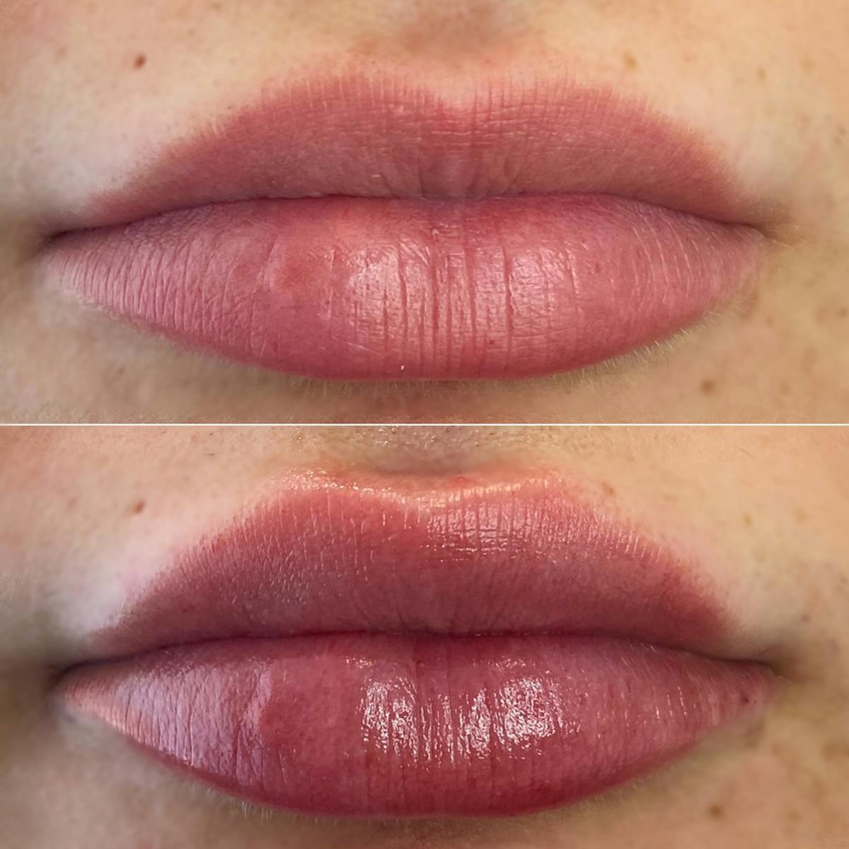 Full Pout® Before & After Gallery - Patient 65643470 - Image 1