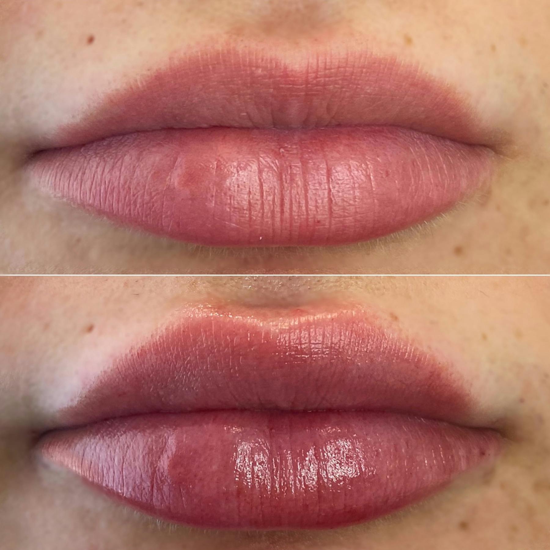 Full Pout® Before & After Gallery - Patient 65643470 - Image 1