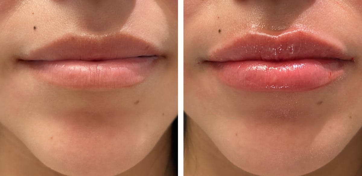 Full Pout® Before & After Gallery - Patient 65643471 - Image 1