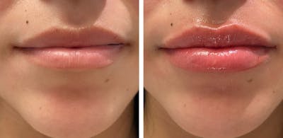 Full Pout® Before & After Gallery - Patient 65643471 - Image 1