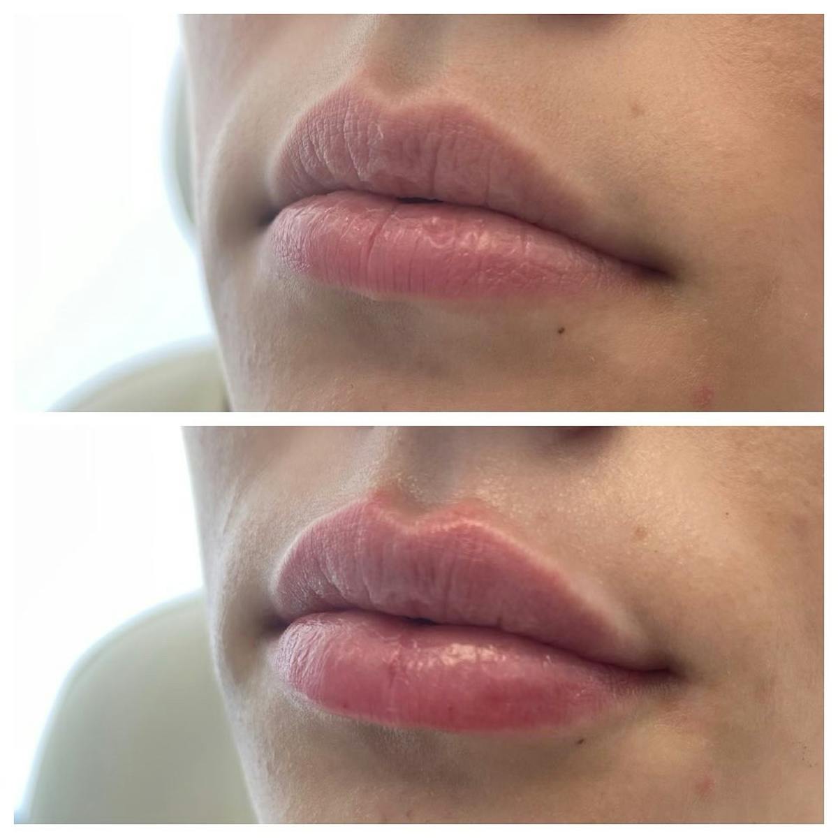 Full Pout® Before & After Gallery - Patient 65643472 - Image 1