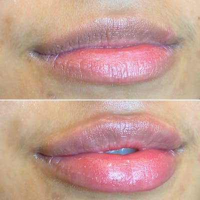 Full Pout® Before & After Gallery - Patient 65643474 - Image 1