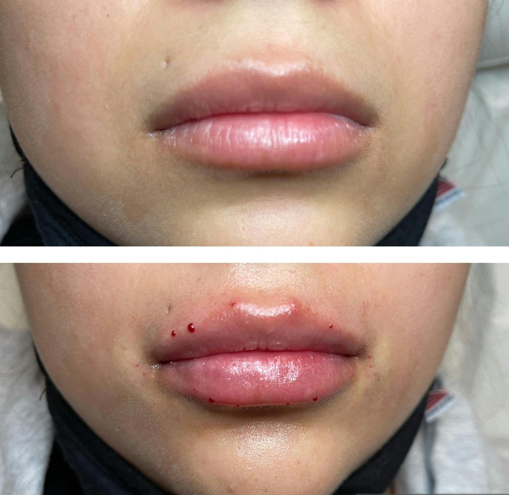 Full Pout® Before & After Gallery - Patient 65643475 - Image 1