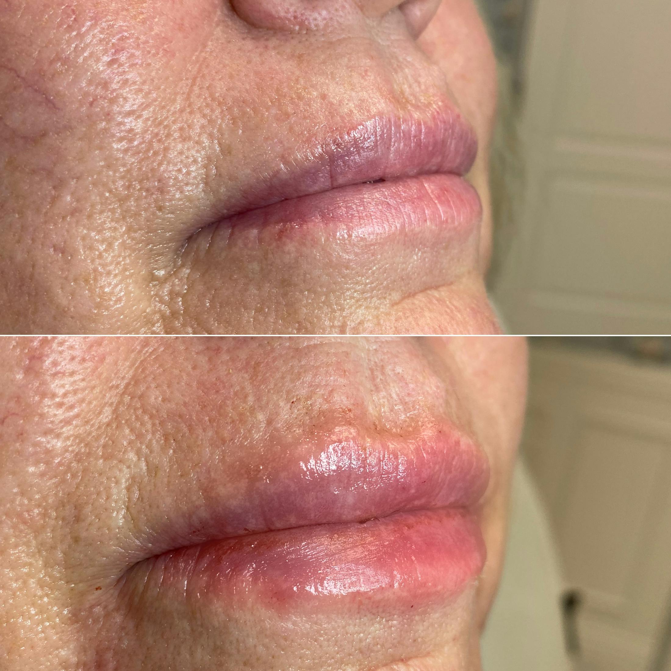 Full Pout® Before & After Gallery - Patient 65643476 - Image 1