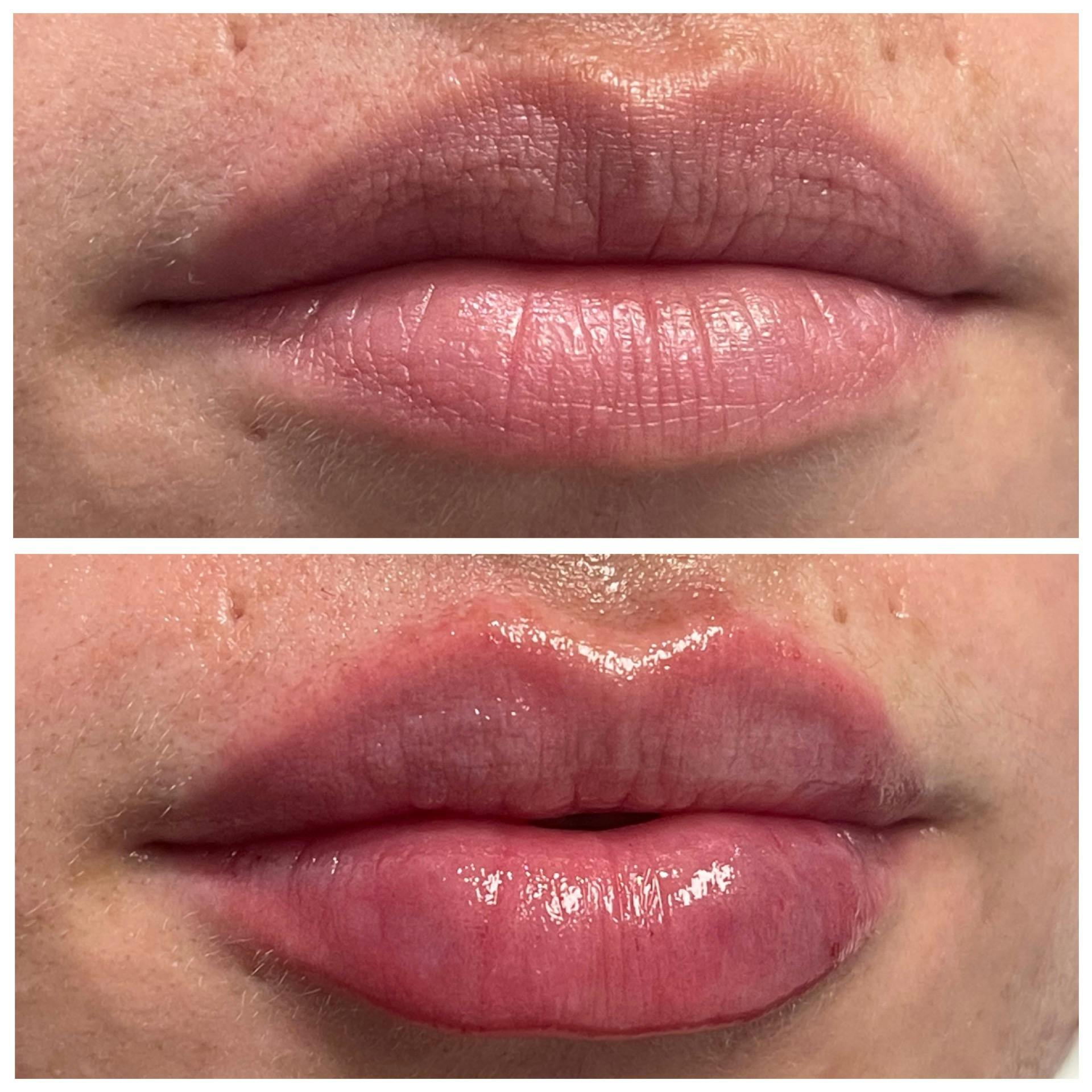 Full Pout® Before & After Gallery - Patient 65643477 - Image 1