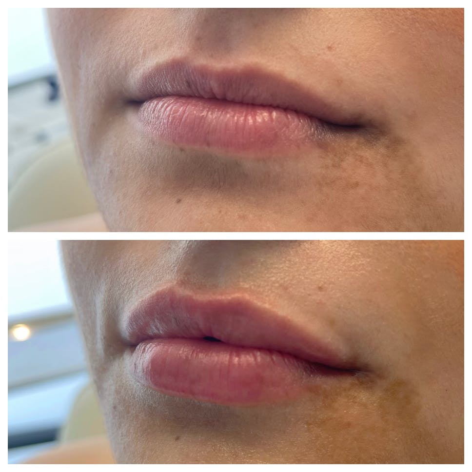 Full Pout® Before & After Gallery - Patient 65643478 - Image 1