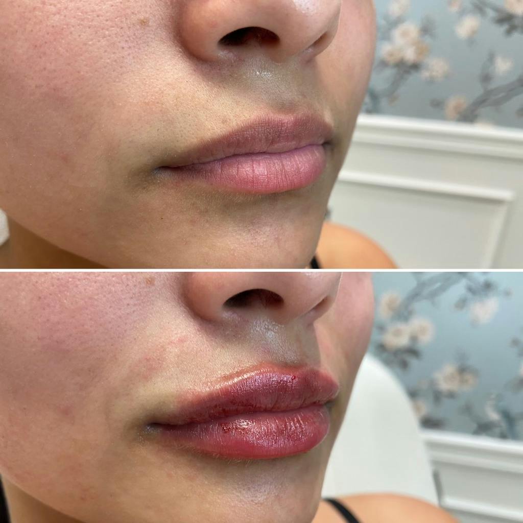 Full Pout® Before & After Gallery - Patient 65643479 - Image 1