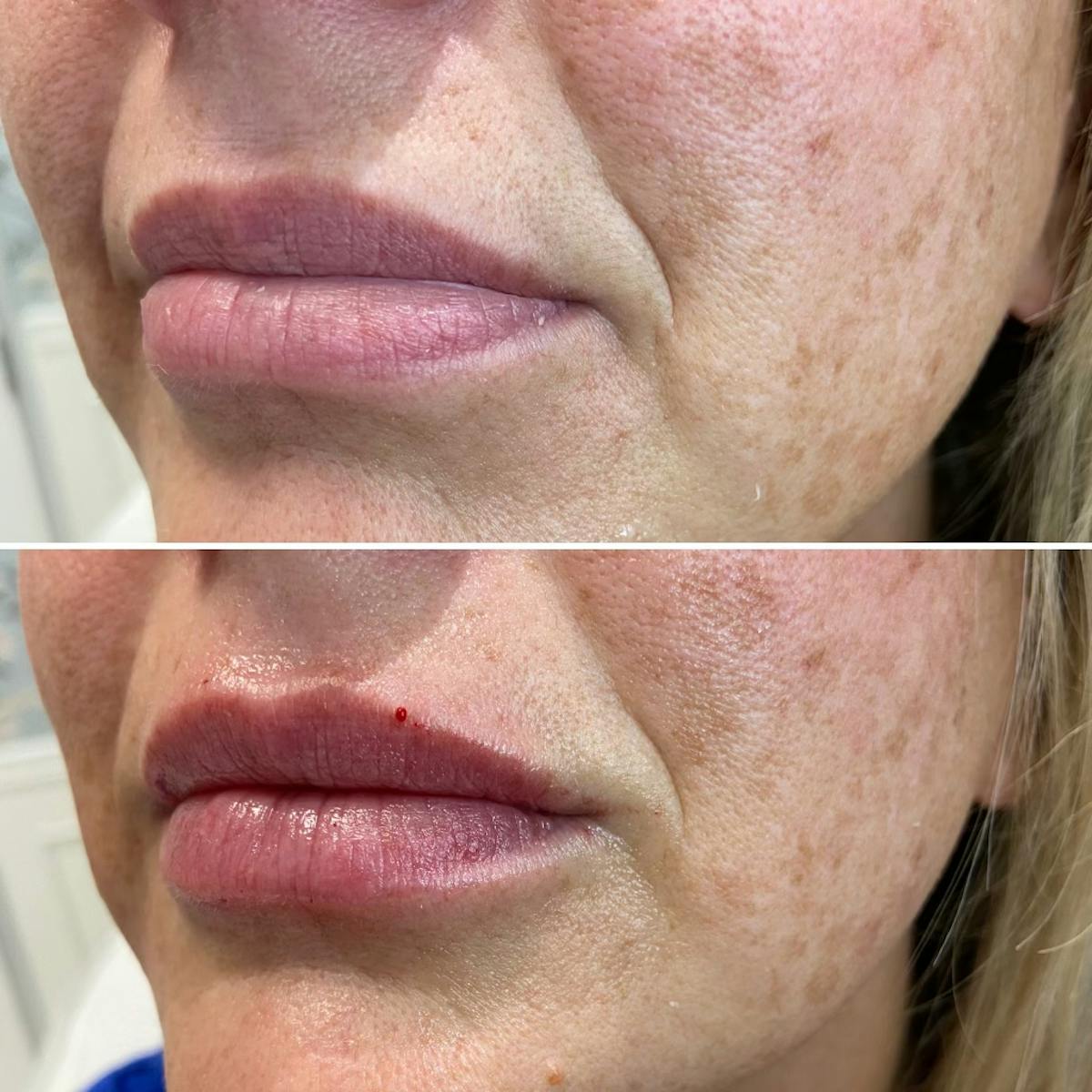 Full Pout® Before & After Gallery - Patient 65643480 - Image 1