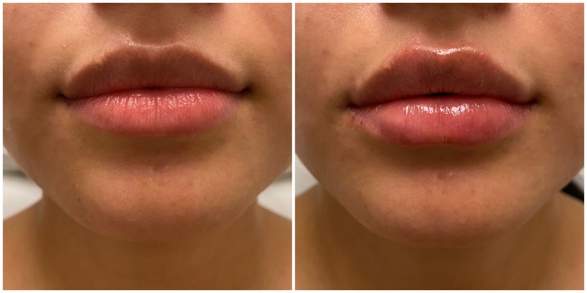 Full Pout® Before & After Gallery - Patient 65643481 - Image 1