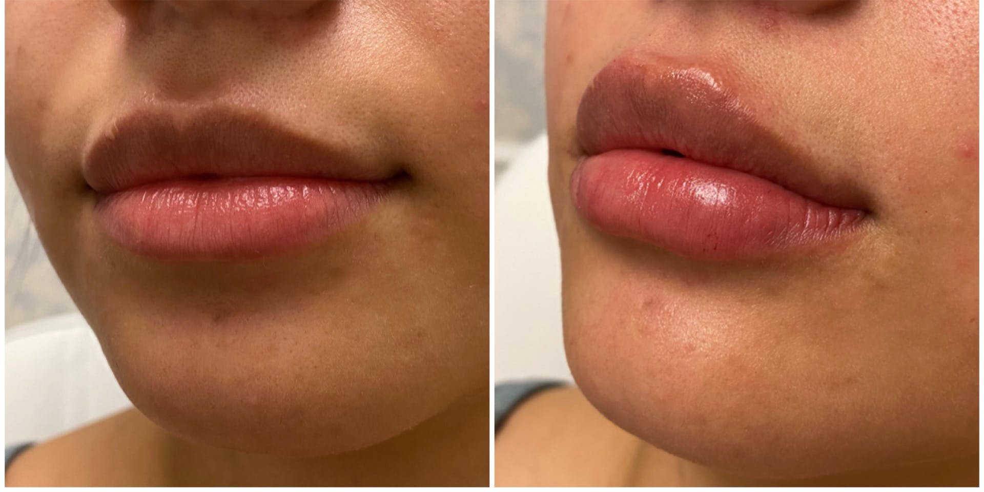 Full Pout® Before & After Gallery - Patient 65643481 - Image 2