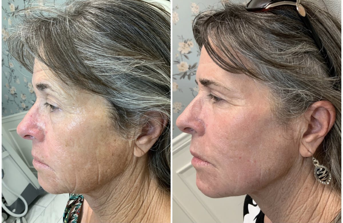 Magic Laser Eraser (Face) Before & After Gallery - Patient 65643483 - Image 1