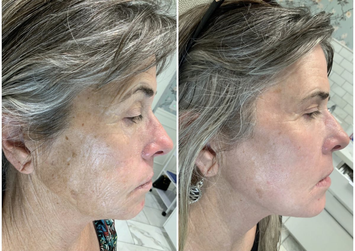 Magic Laser Eraser (Face) Before & After Gallery - Patient 65643483 - Image 2