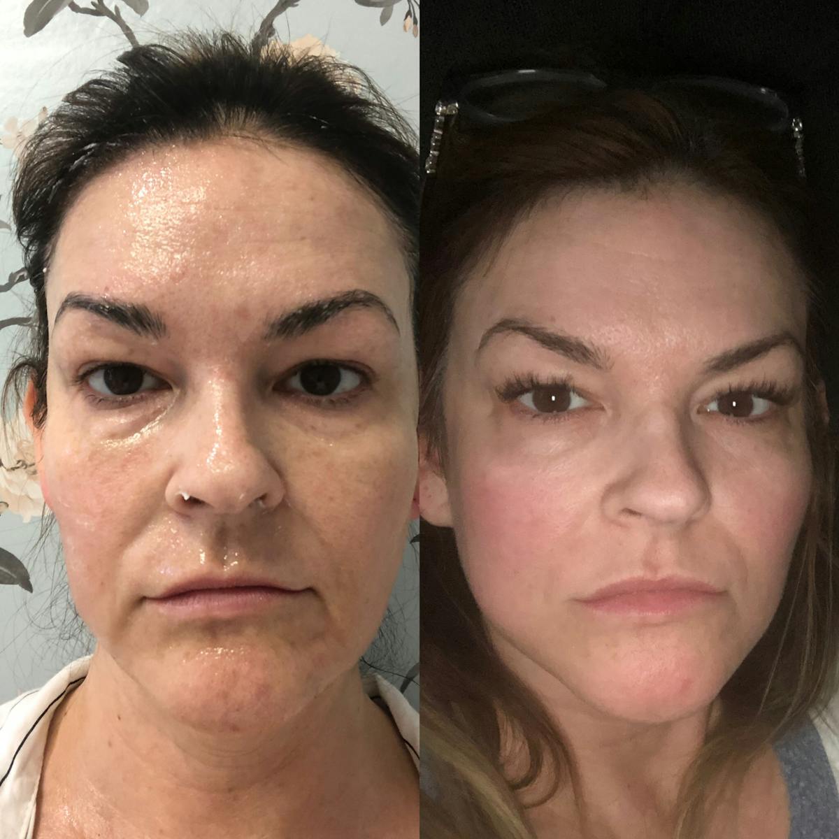 Magic Laser Eraser (Face) Before & After Gallery - Patient 65643484 - Image 1