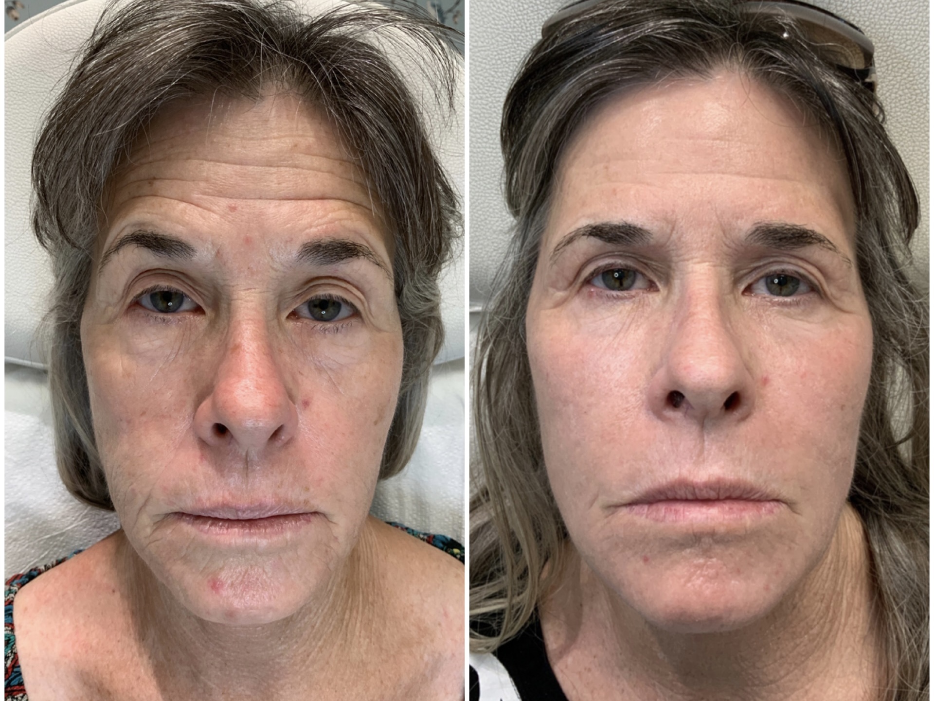 Magic Laser Eraser Bakersfield & Kern CA EuroPhoria Medical