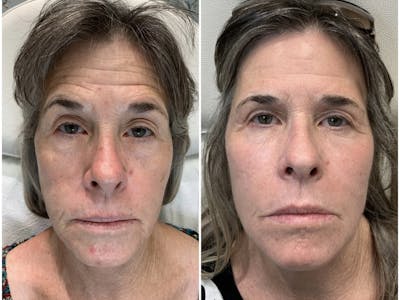 Magic Laser Eraser (Face) Before & After Gallery - Patient 65643485 - Image 1